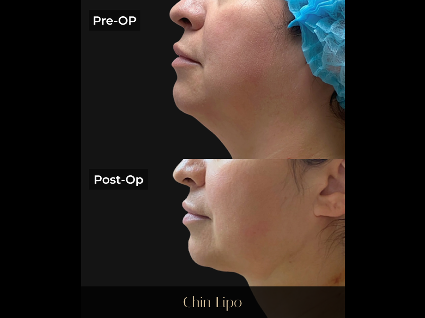 Side-by-side before and after profile showing chin lipo results with reduced submental fullness