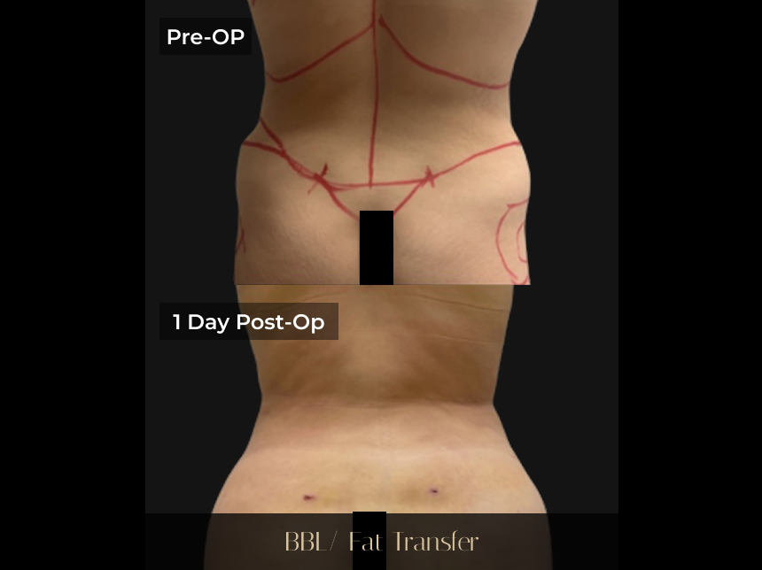 Pre-op and 1 day post-op comparison of BBL/Fat Transfer procedure showing surgical markings and early results