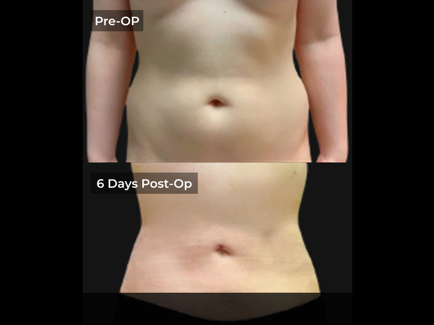 Before and after abdominal liposuction: pre-op photo shows fuller midsection, 6 days post-op shows reduced contour
