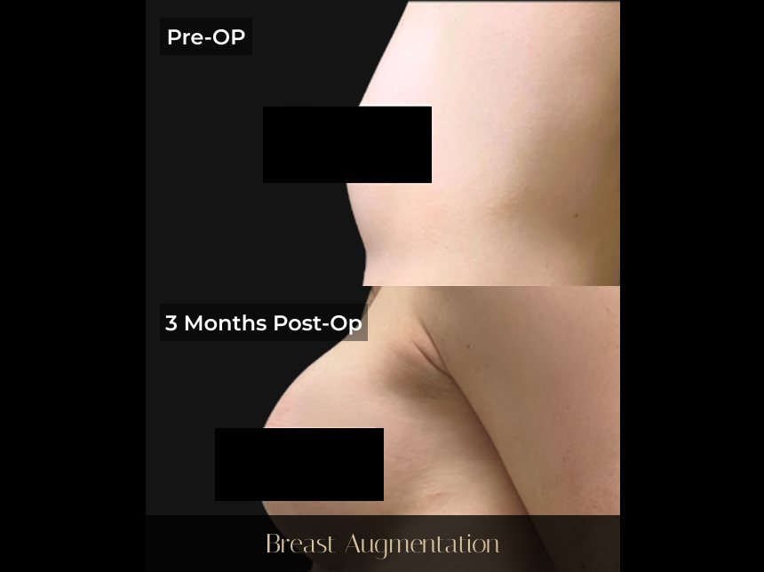 Before and after breast augmentation comparison: pre-op and 3 months post-op side profile views