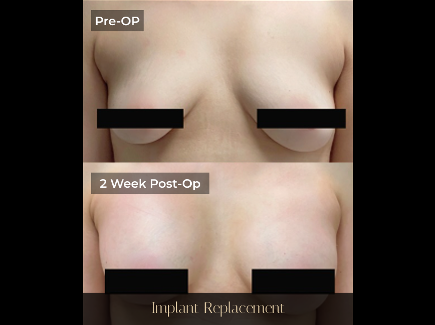 Before and after breast implant replacement: pre-operative and 2-week post-operative comparison