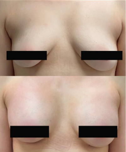 Before and after breast augmentation results showing improved volume and symmetry