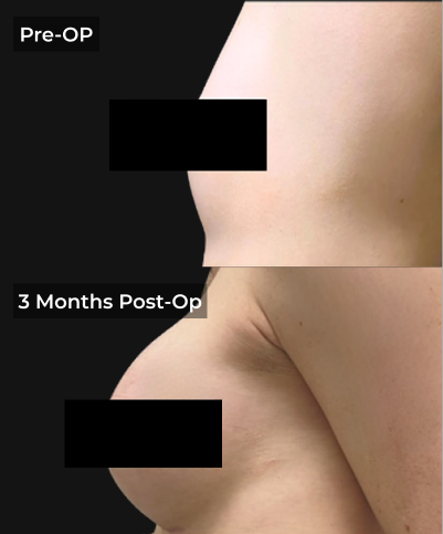Before and after liposuction results showing torso profile pre-op and 3 months post-op