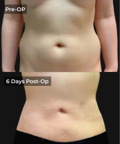 Before and after liposuction results showing abdominal contouring at pre-op and 6 days post-op