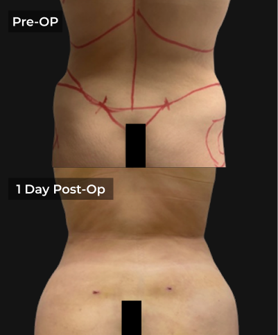 Before and after liposuction: pre-op marking with surgical lines and 1 day post-op result showing reduced contours