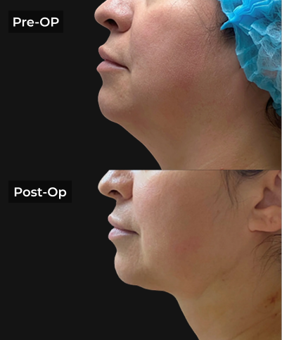 Before and after side profile showing reduced jawline fullness post-liposuction procedure