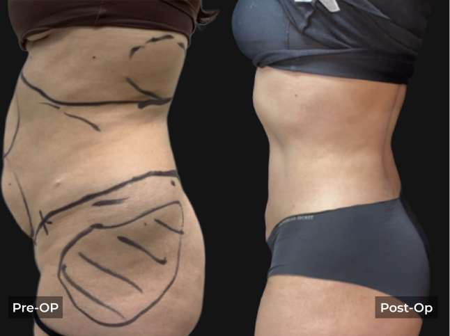 Before and after liposuction results showing marked abdominal and waist contouring