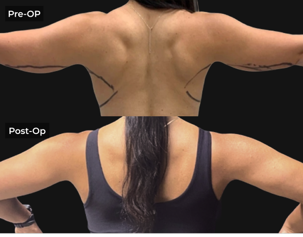 Before and after back view showing arm liposuction results at LipoSculp