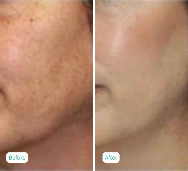 Hydroglow Facial - Case 1