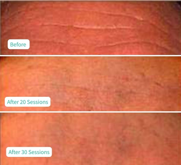 LED Rejuvenation - Case 1