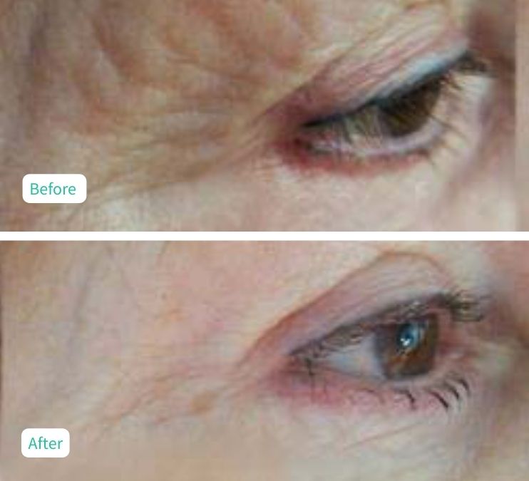 LED Rejuvenation - Case 2