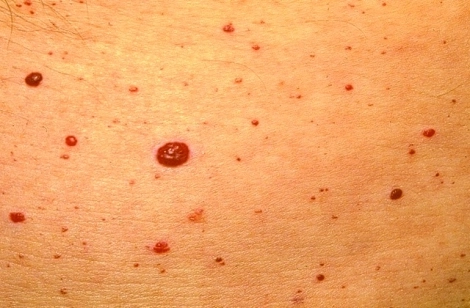 Cherry Type Rash Specialized Skin Issue Solutions | Beautify Spa
