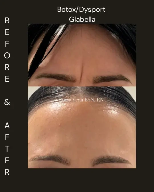 Botox