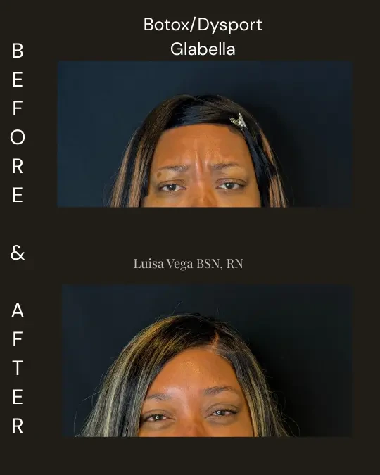 Botox Dysport 1