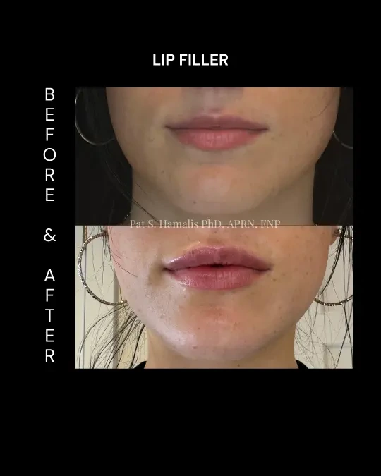Filler 13