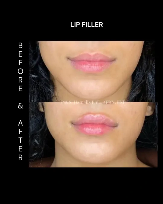 Filler 14