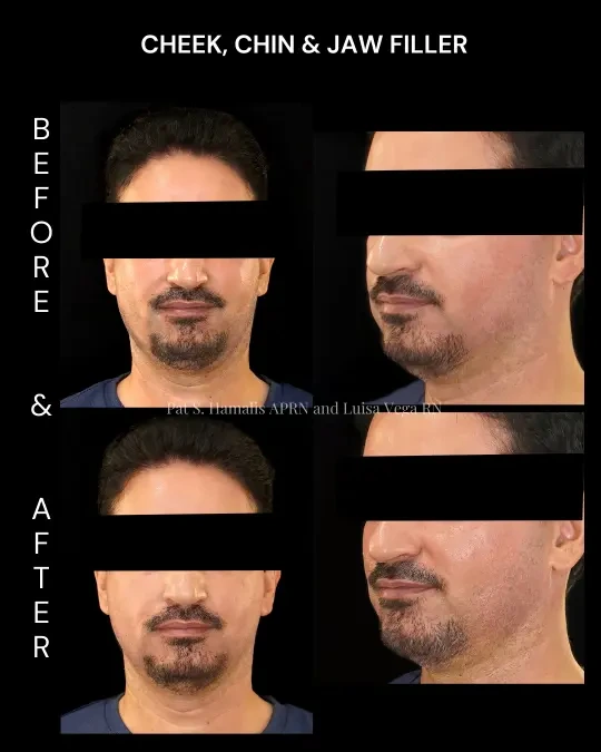 Filler 2