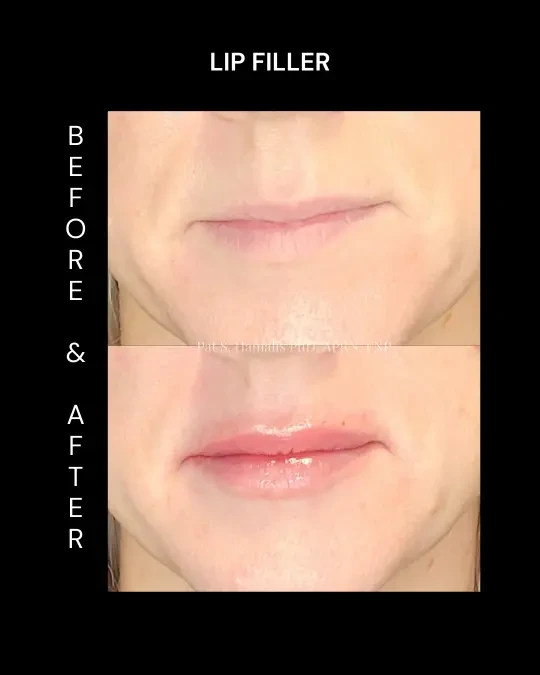Filler 3