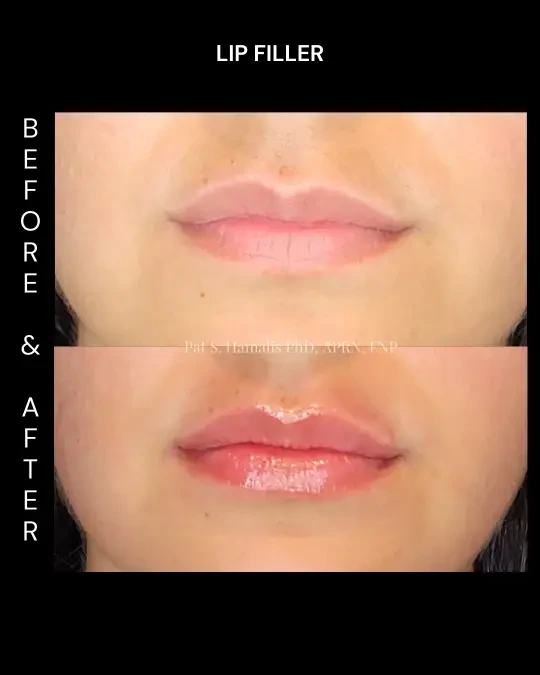 Filler 4