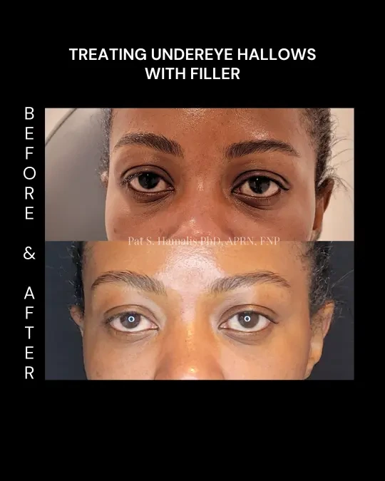 Filler 7