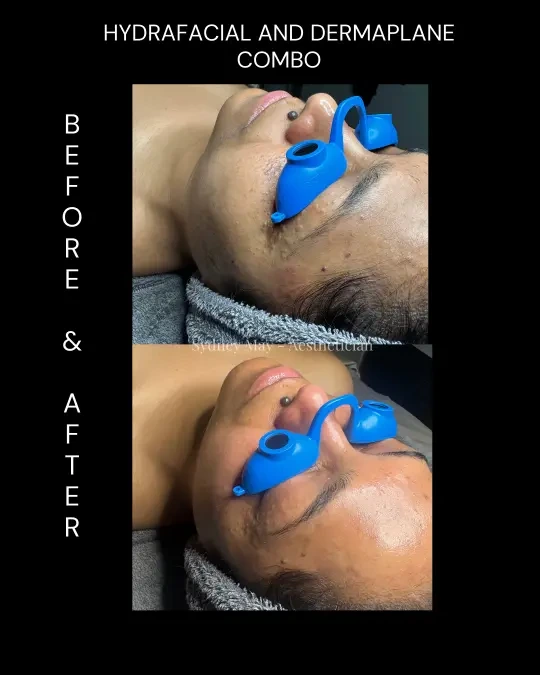 Hydrafacial Dermaplane 9