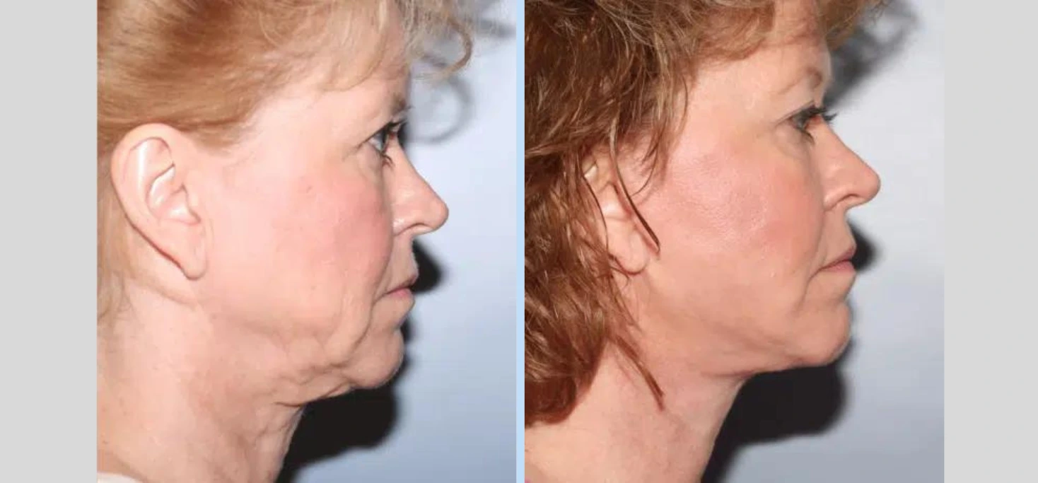 TemplateBefore After (44)