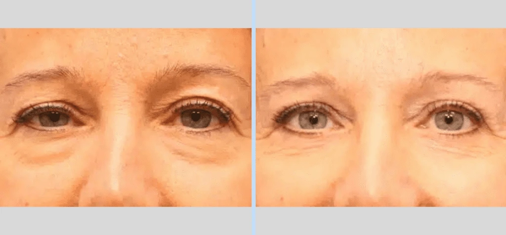 Blepharoplasty Before & After - Case 1