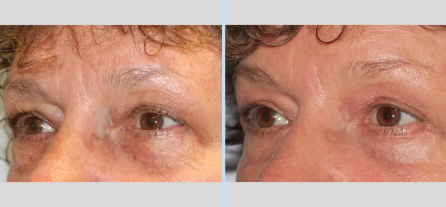 Blepharoplasty Before & After - Case 2