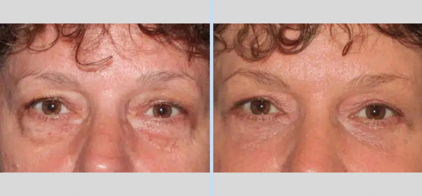 Blepharoplasty Before & After - Case 2
