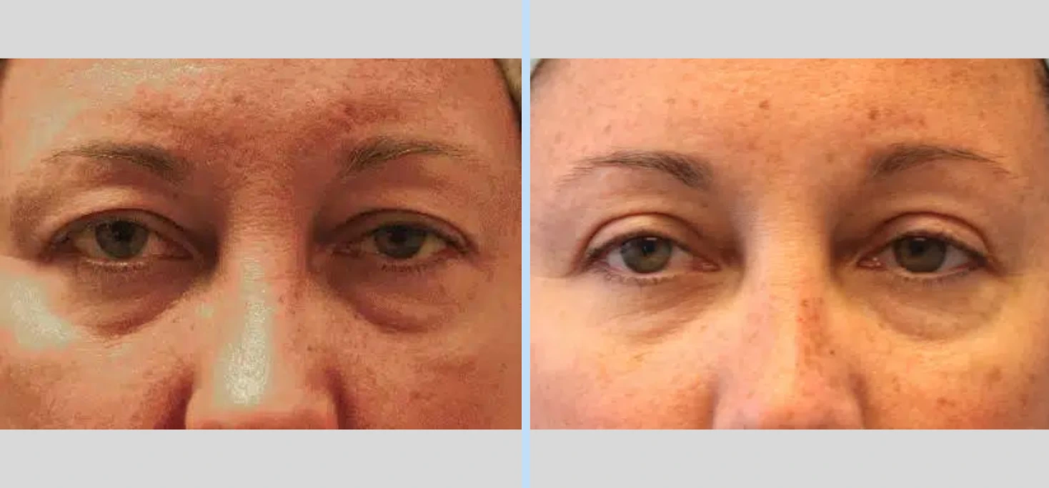 Blepharoplasty Before & After - Case 3