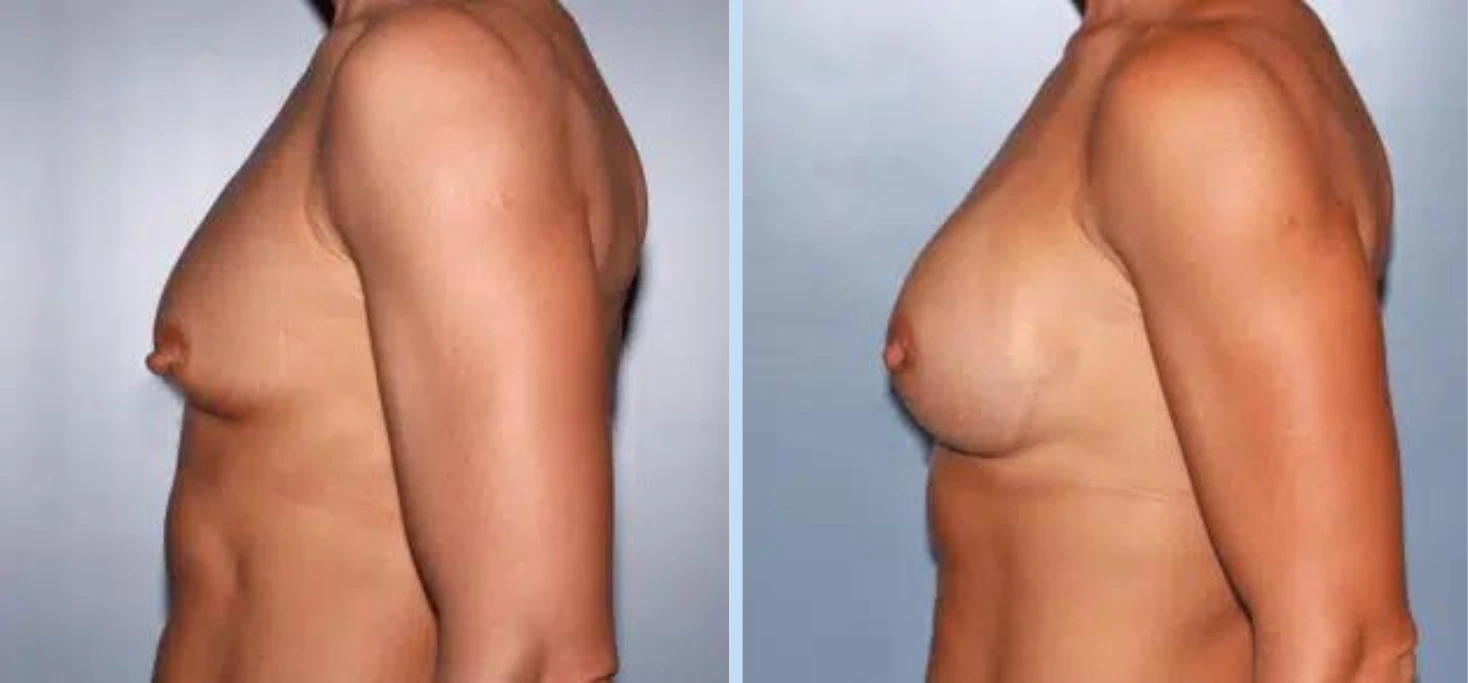 Breast Augmentation Before & After - Case 1 Banner