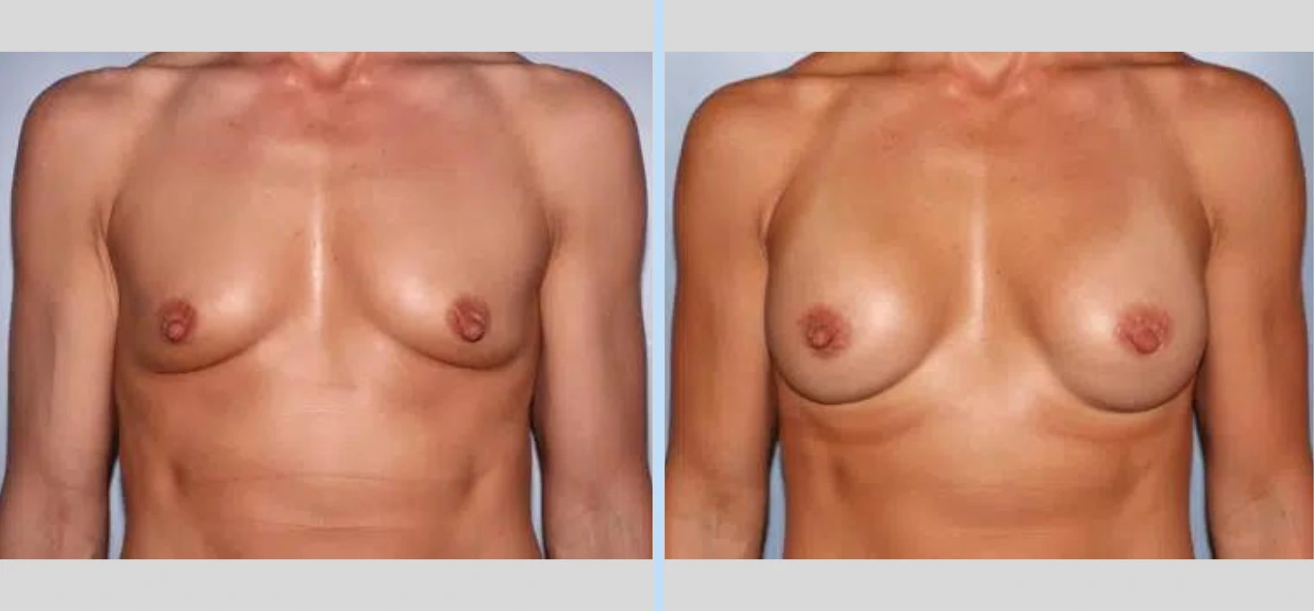 Breast Augmentation Before & After - Case 1 Banner