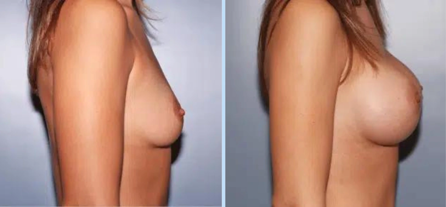 Breast Augmentation Before & After - Case 10 Banner
