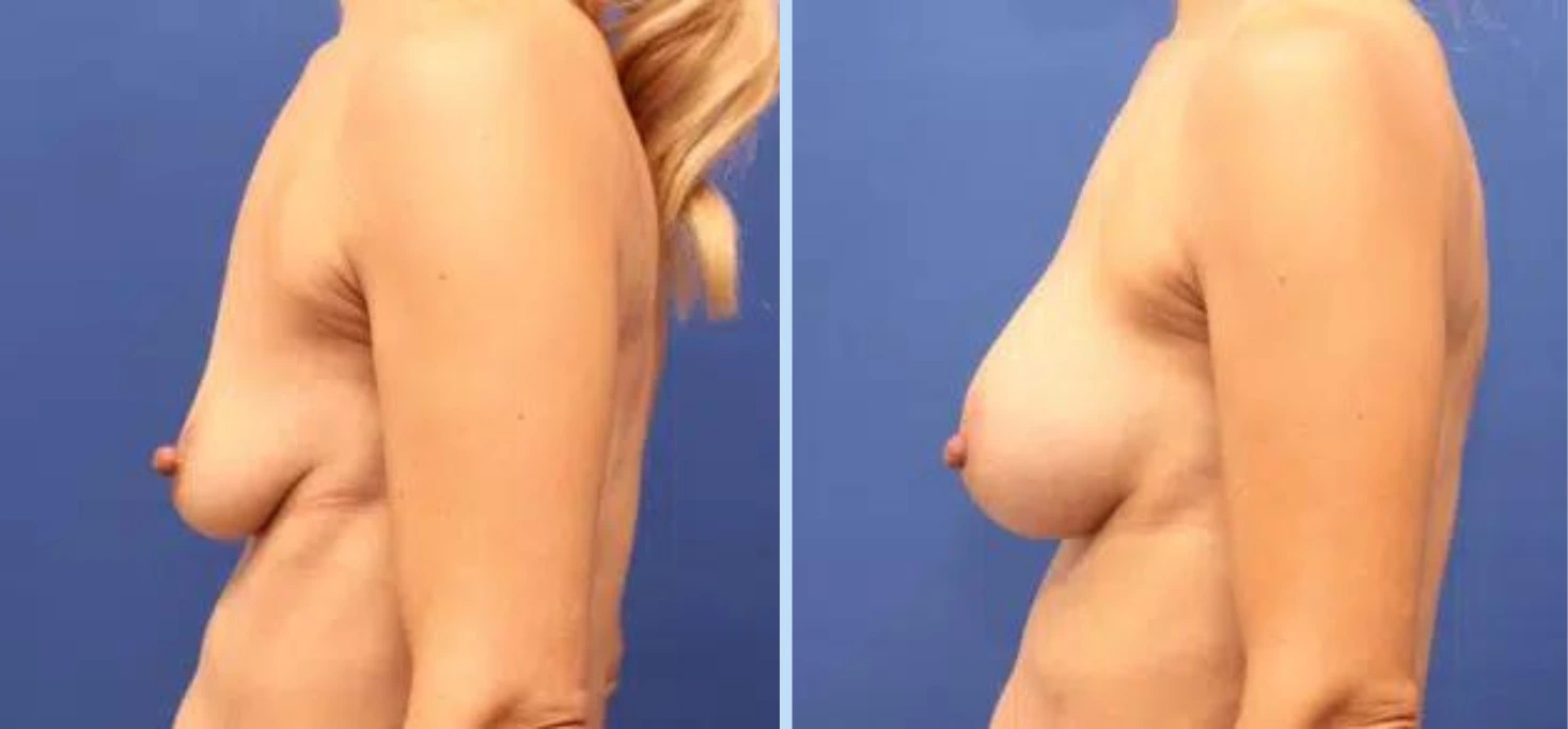 Breast Augmentation Before & After - Case 11
