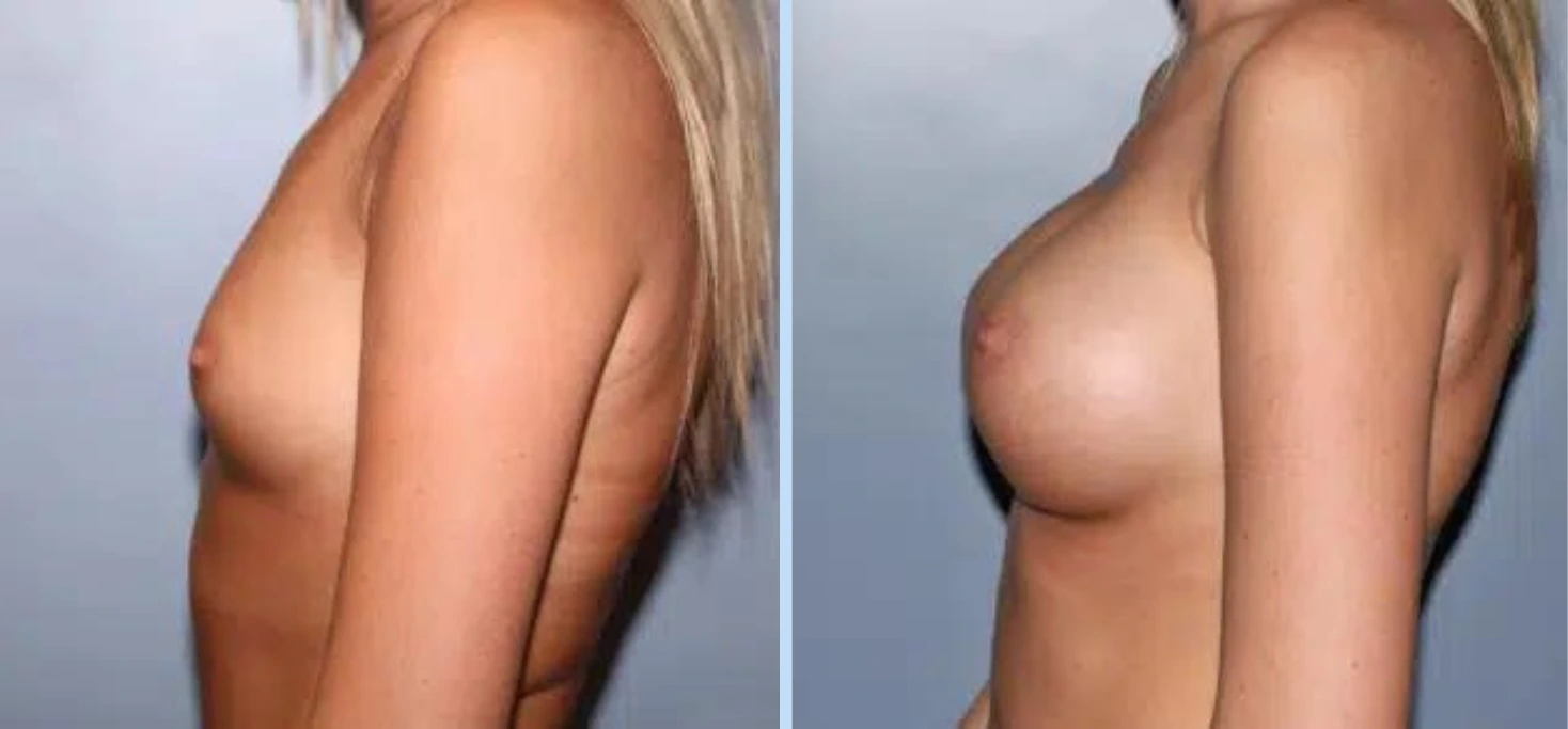 Breast Augmentation Before & After - Case 12 Banner