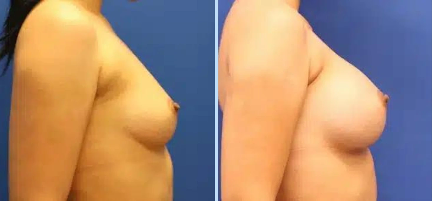 Breast Augmentation Before & After - Case 13 Banner