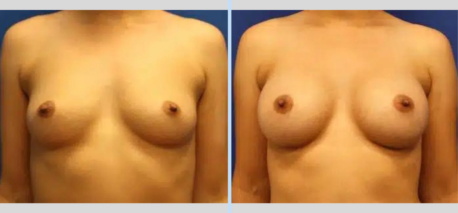 Breast Augmentation Before & After - Case 13 Banner