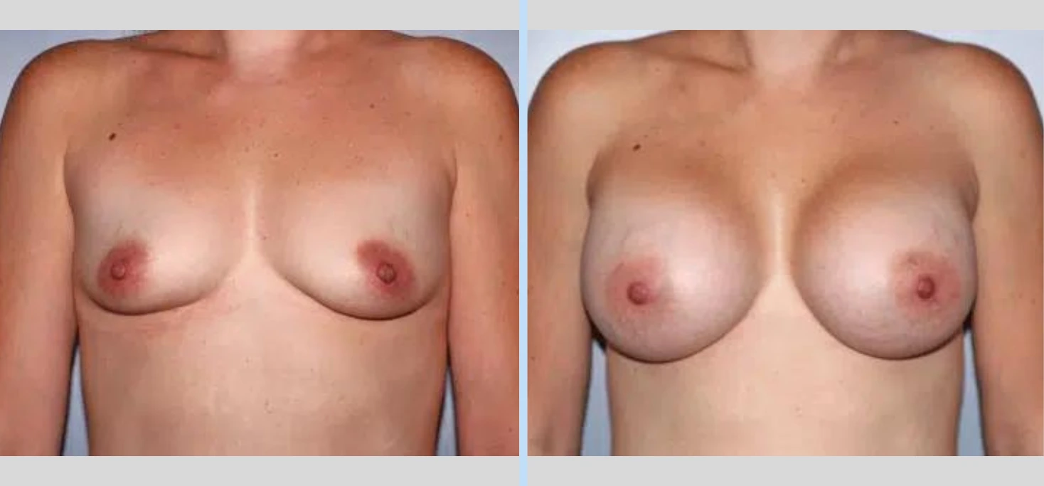 Breast Augmentation Before & After - Case 14 Banner