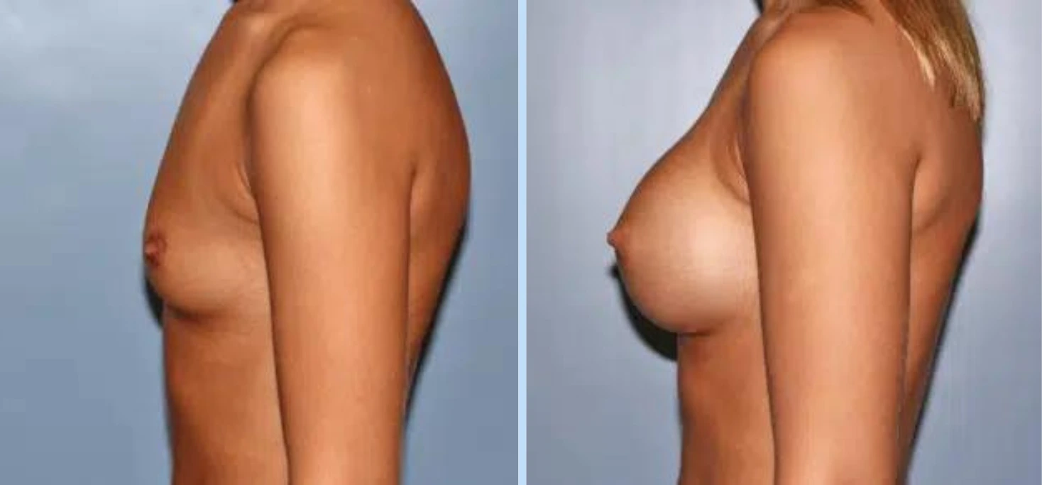 Breast Augmentation Before & After - Case 15 Banner