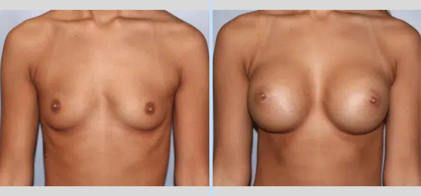 Breast Augmentation Before & After - Case 15 Banner