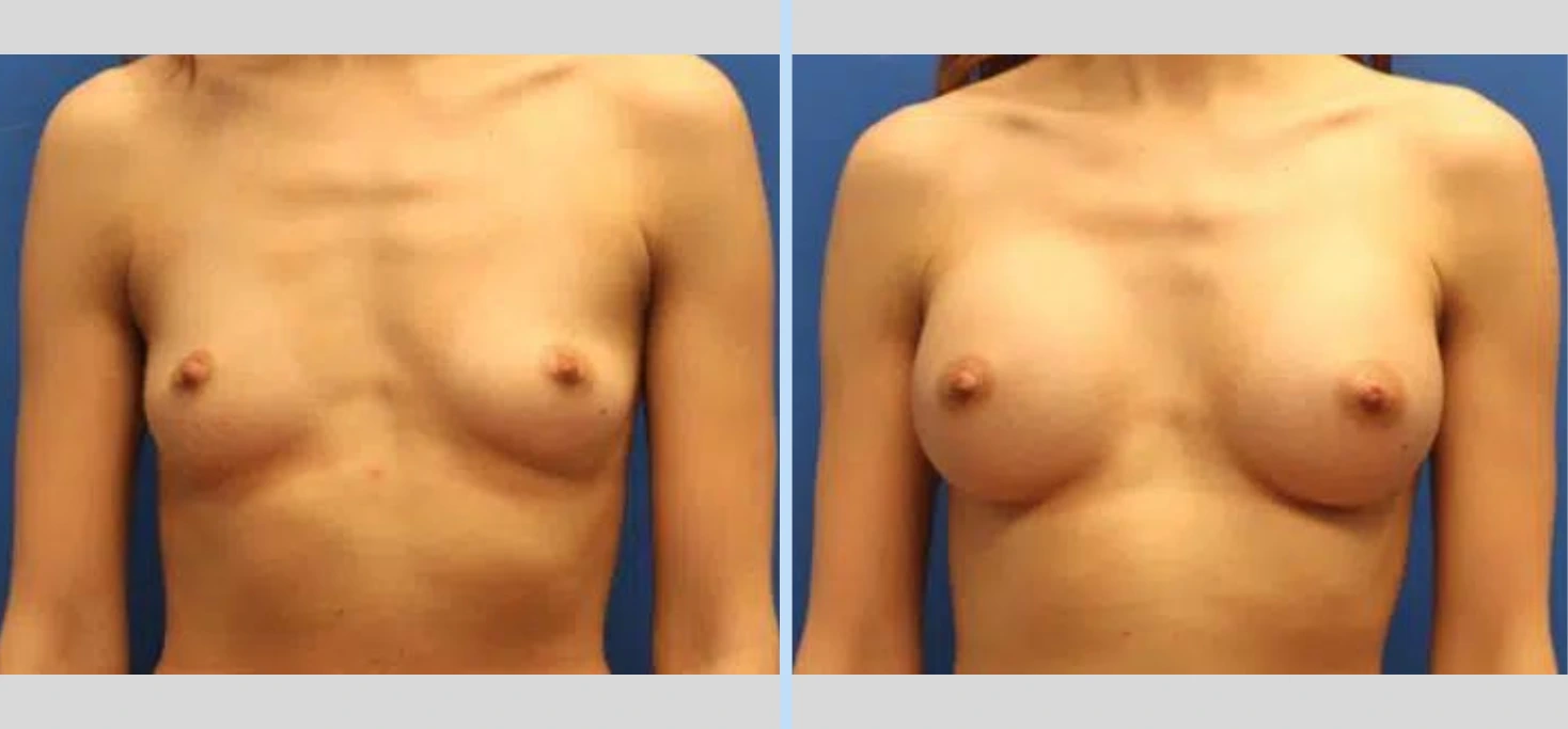 Breast Augmentation Before & After - Case 2 Banner