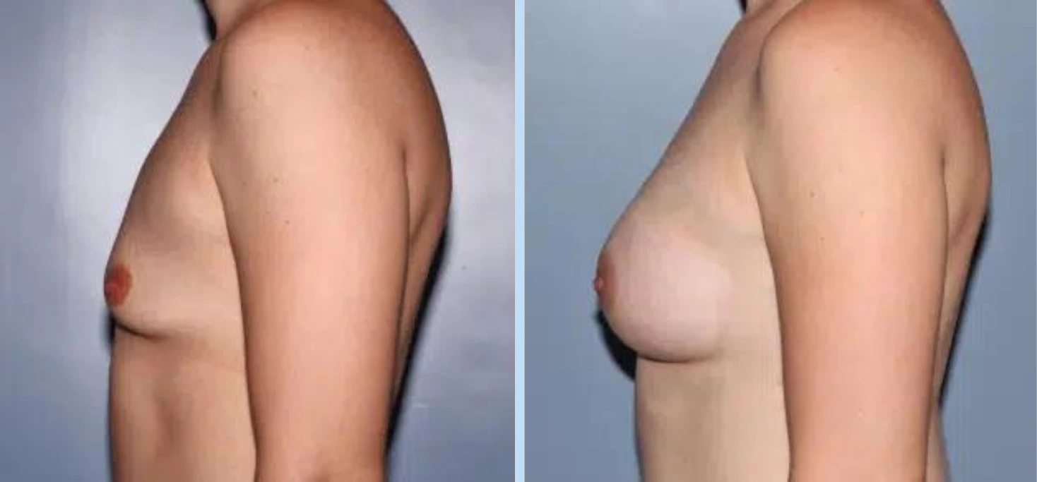 Breast Augmentation Before & After - Case 20