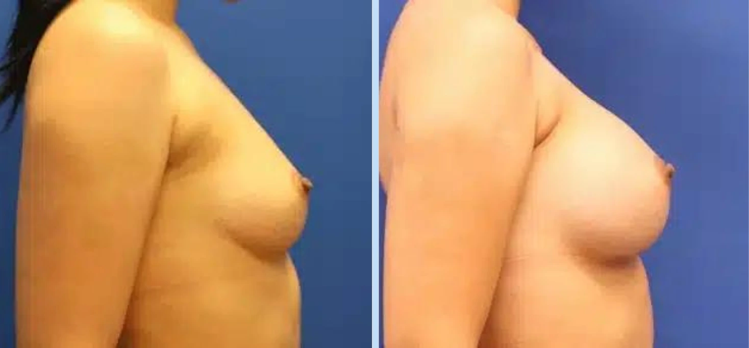 Breast Augmentation Before & After - Case 21