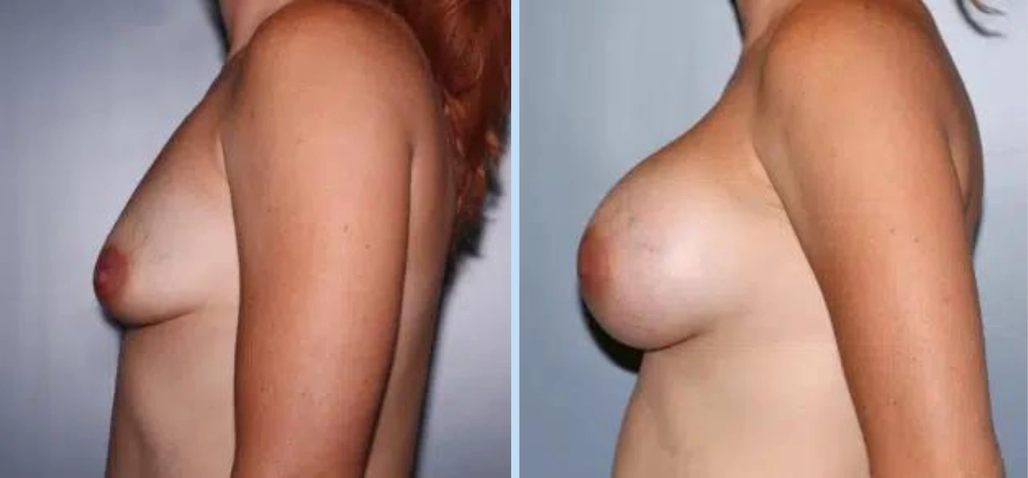 Breast Augmentation Before & After - Case 22