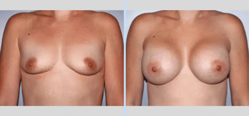 Breast Augmentation Before & After - Case 22