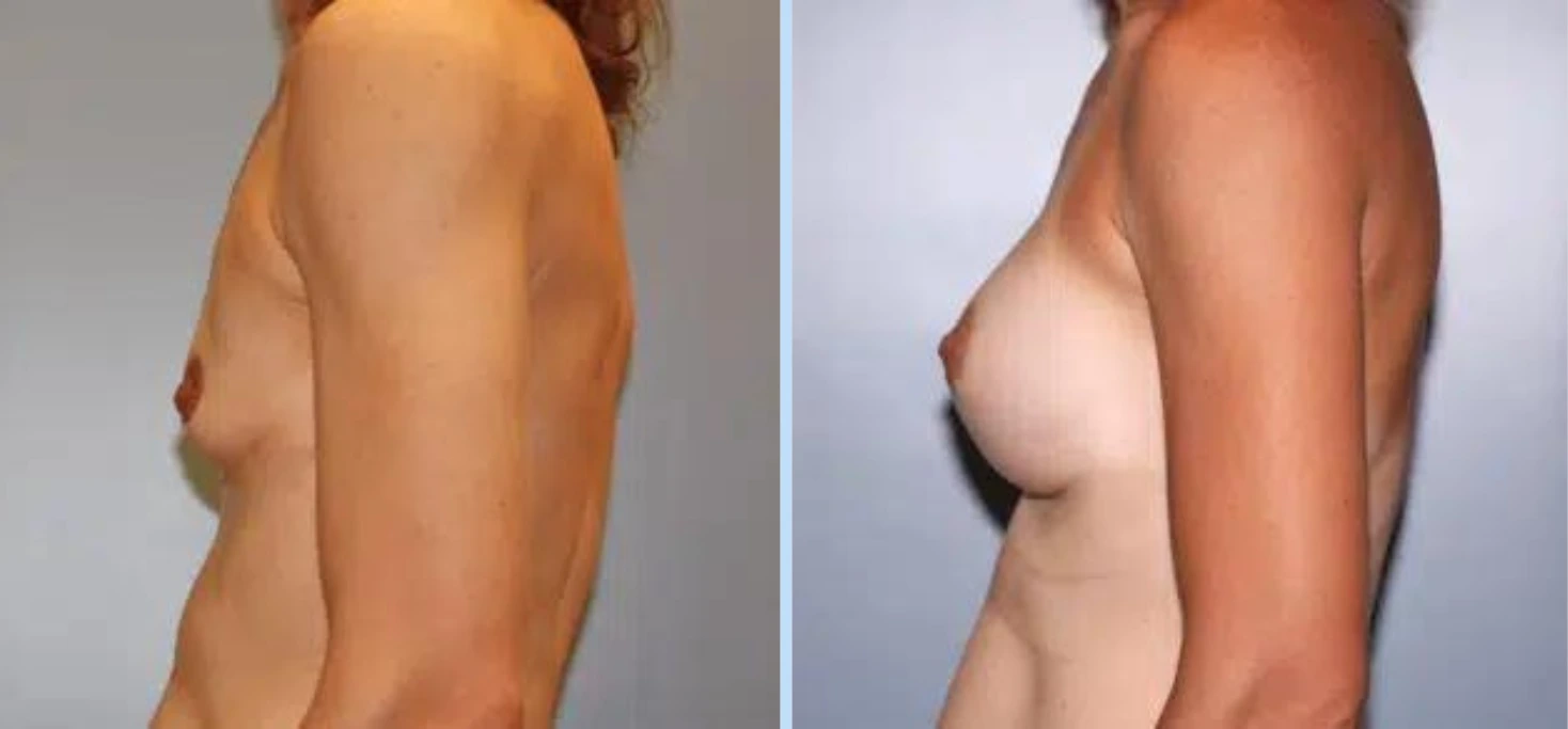 Breast Augmentation Before & After - Case 26