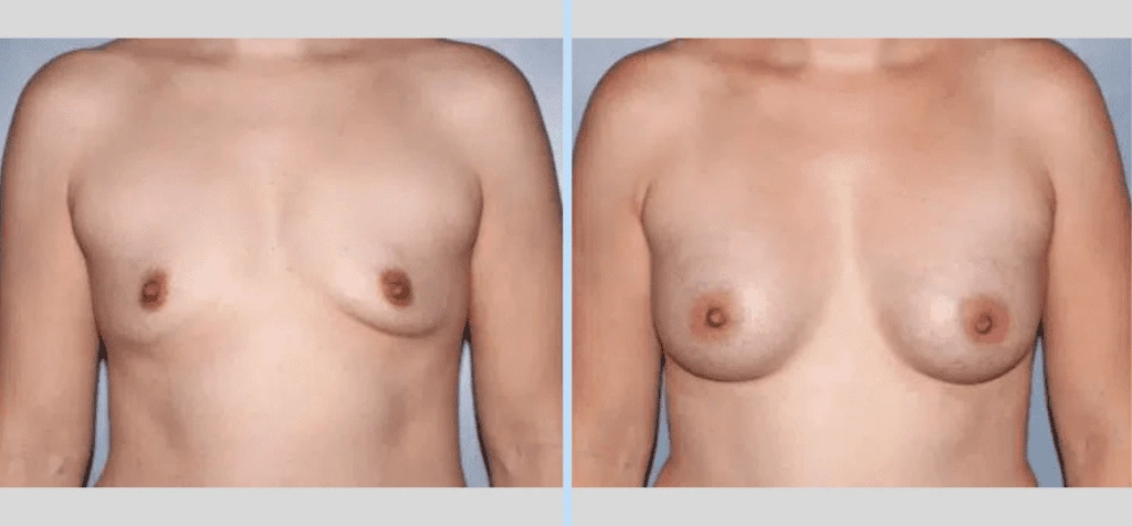 Breast Augmentation Before & After - Case 28