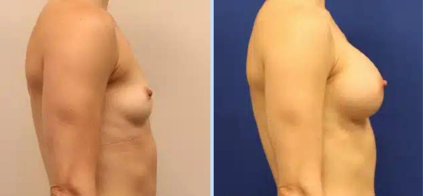 Breast Augmentation Before & After - Case 29
