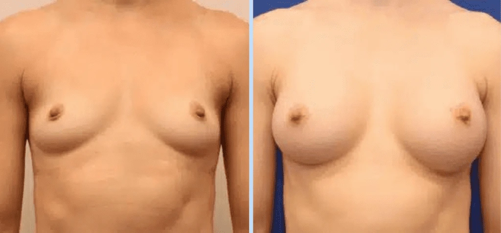 Breast Augmentation Before & After - Case 29