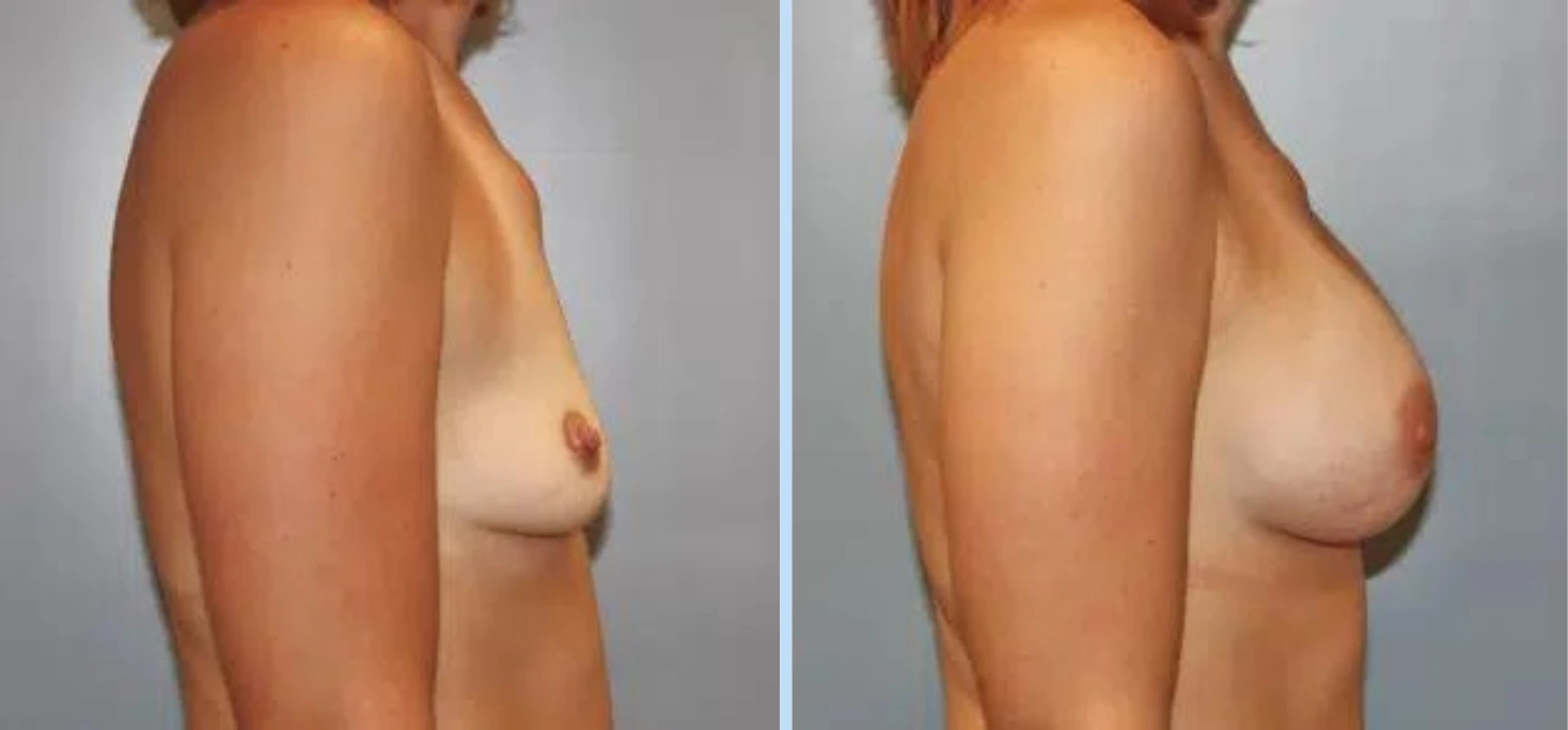 Breast Augmentation Before & After - Case 3 Banner